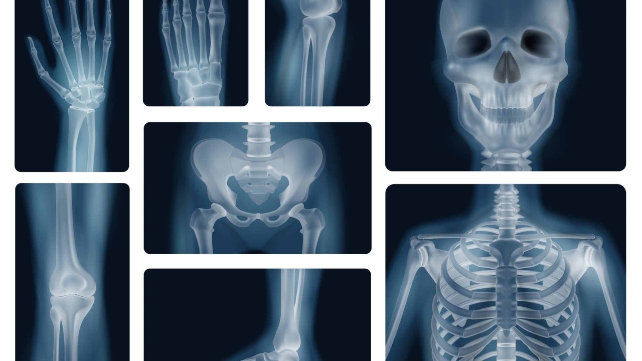 e-possivel-quebrar-todos-os-ossos-de-uma-so-vez?