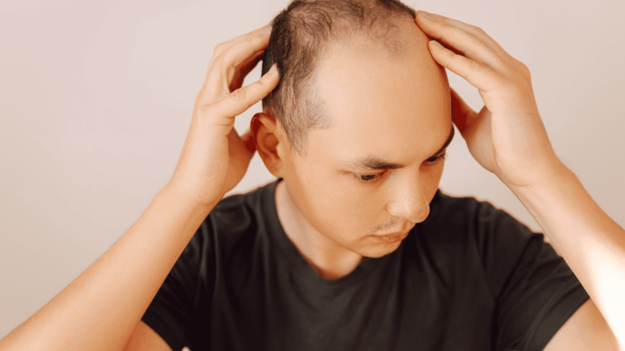 quais-as-causas-da-calvicie?-veja-por-que-a-queda-de-cabelo-acontece