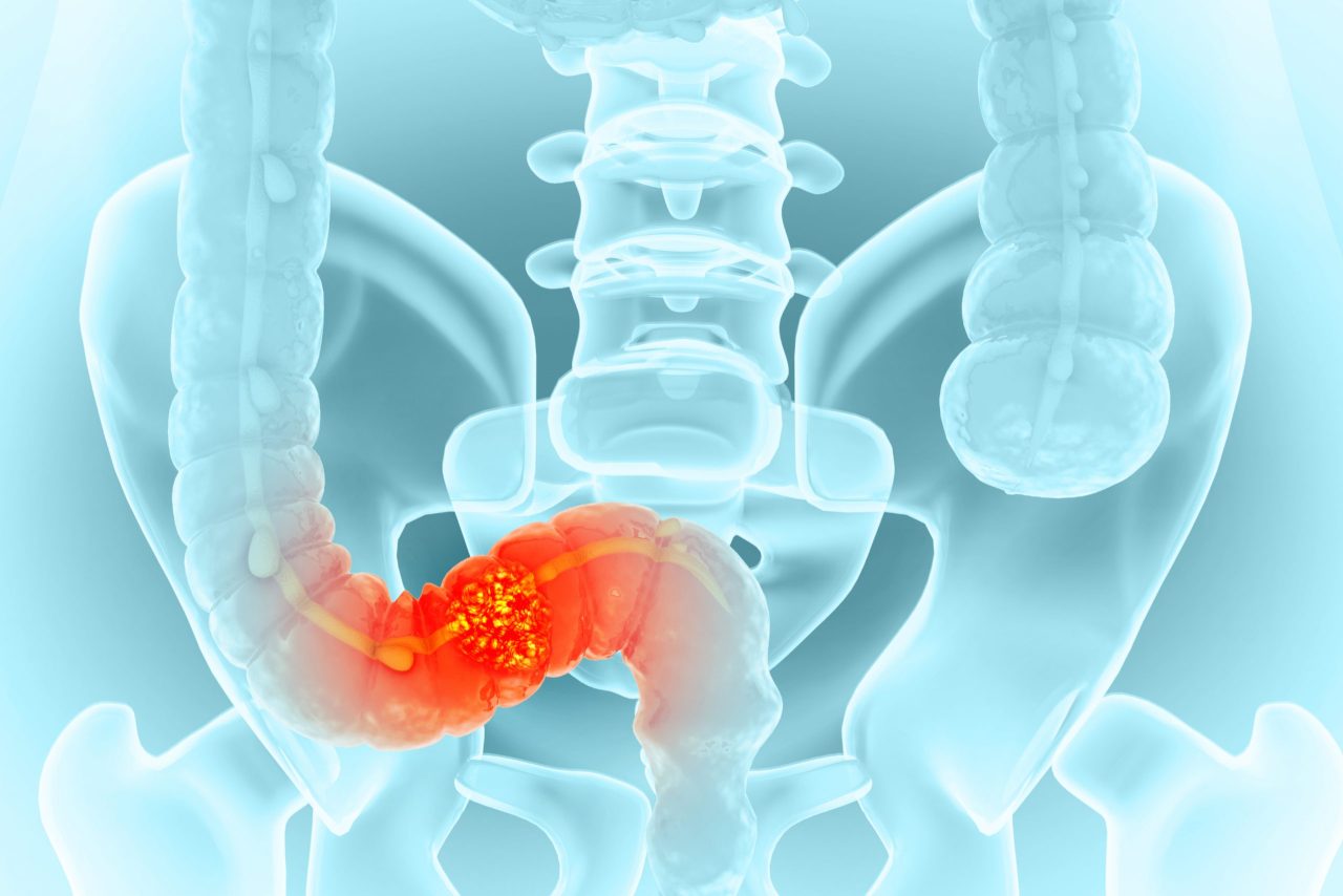 toxina-aumenta-chance-de-cancer-colorretal-precoce