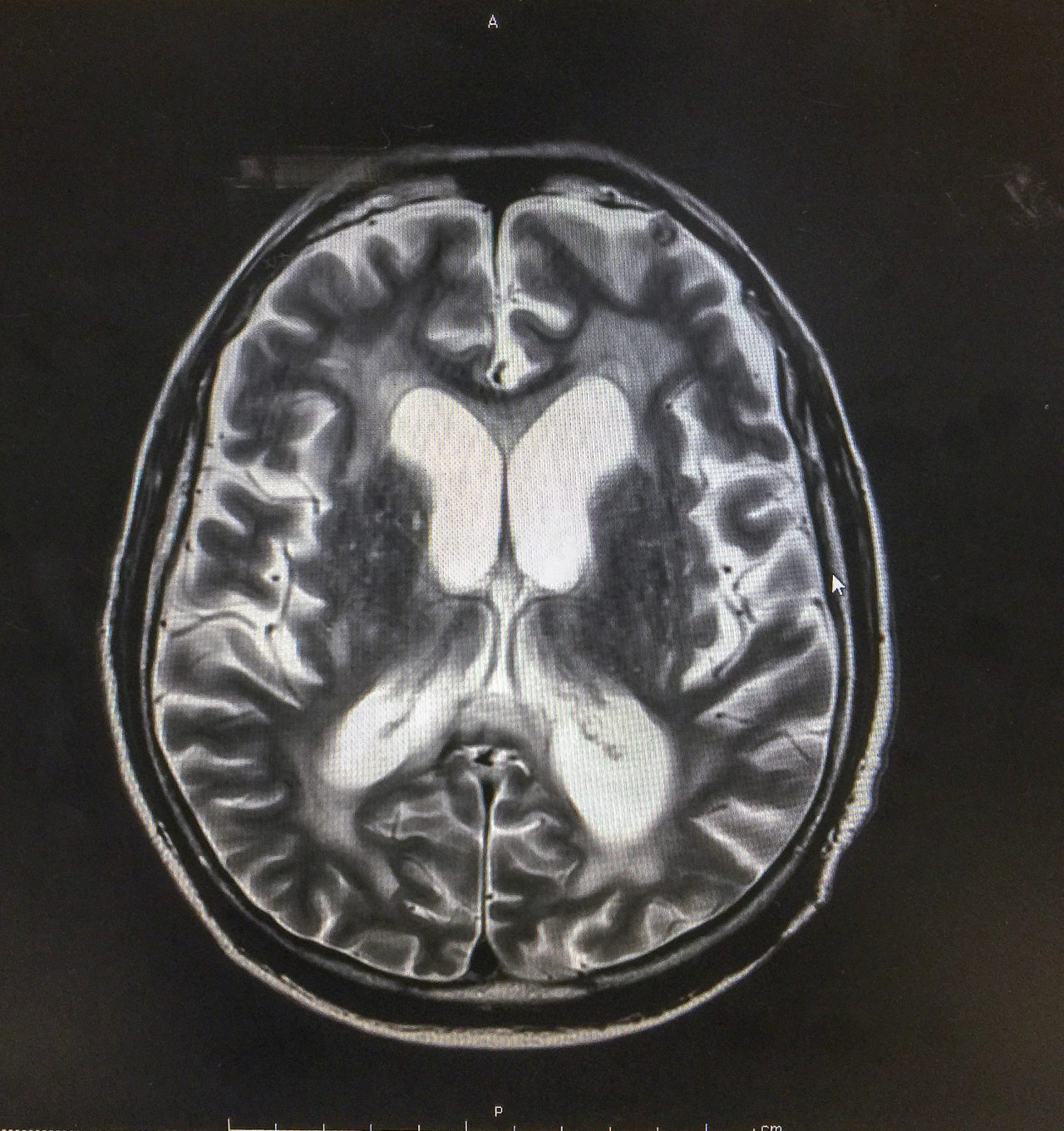 implante-no-cerebro?-entenda-como-e-a-cirurgia-de-chico-buarque
