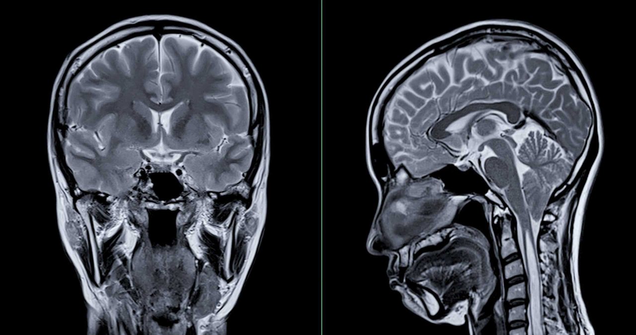 uma-‘foto’-do-seu-cerebro-pode-dizer-se-voce-esta-envelhecendo-rapido