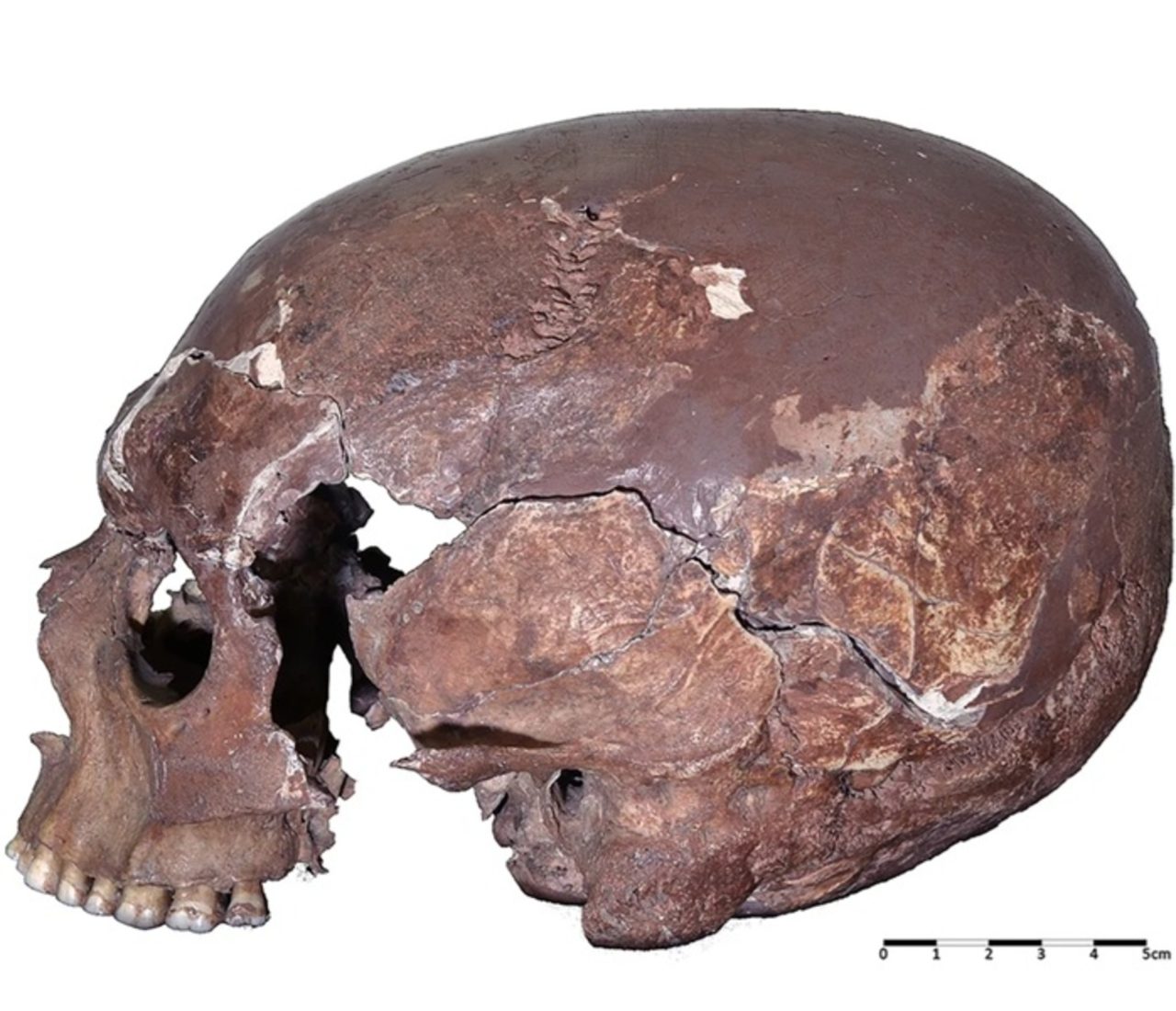 cranio-‘diferentao’-revela-ritual-misterioso-do-passado