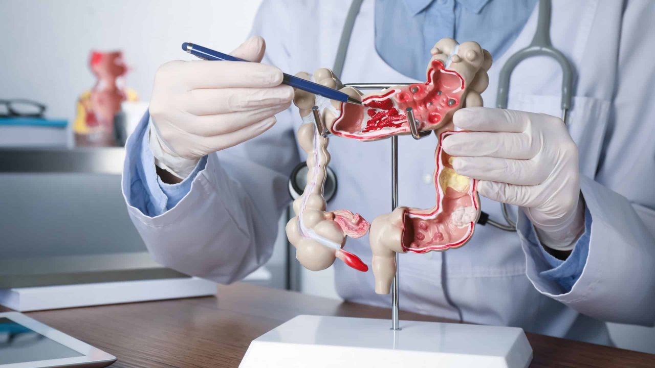 estes-habitos-podem-reduzir-em-ate-30%-o-risco-de-cancer-de-intestino