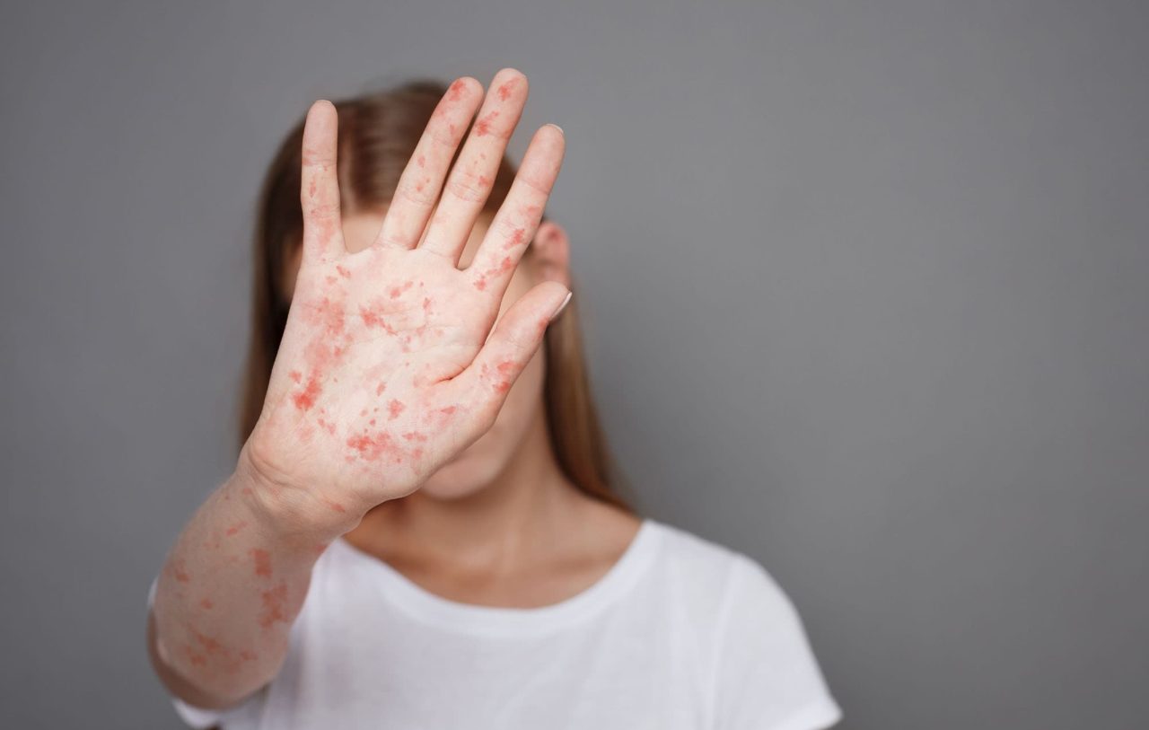 sarampo-volta-a-preocupar:-casos-da-doenca-aumentam-34-vezes-em-um-ano-nas-americas