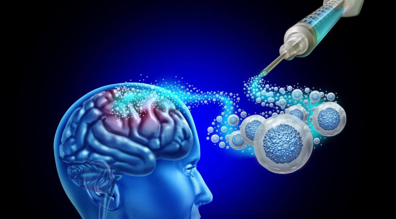 terapias-com-celulas-tronco-avancam-e-revelam-novas-formas-de-regenerar-o-cerebro-apos-avc
