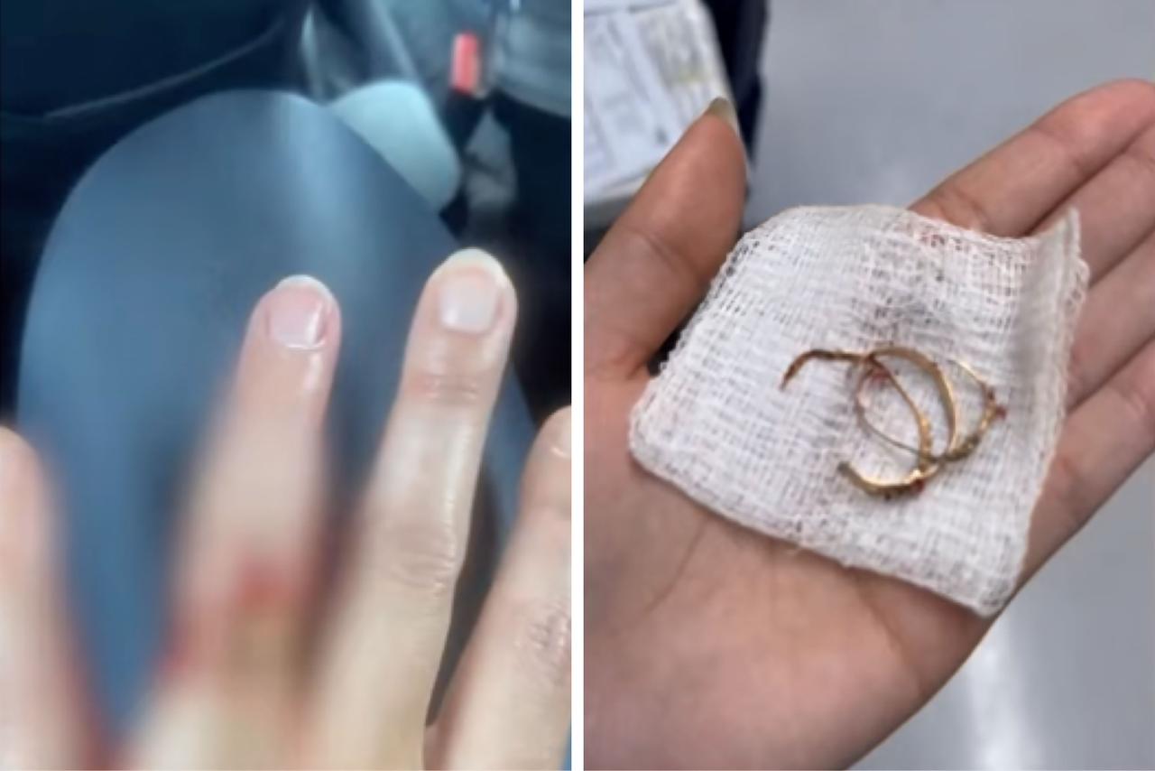 mulher-reage-assalto-e-tem-dedo-mordido-por-assaltante