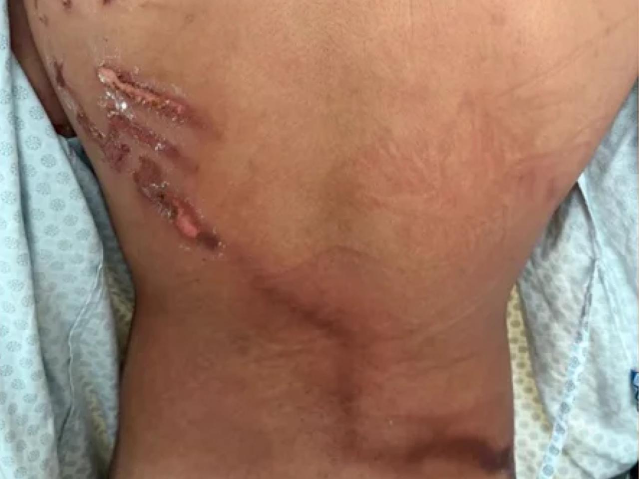 jovem-atingido-por-raio-em-manifestacao-de-nikolas-ferreira-relata-pavor-e-paralisia;-veja