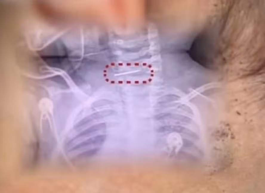 mae-fere-bebe-com-mais-de-600-perfuracoes-e-agulha-fica-presa-na-coluna